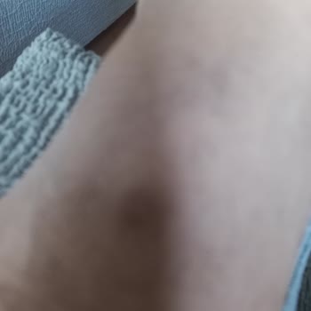 Nike Ayakkabısının Ayağa Yara Vermesi Ve İade Talebi