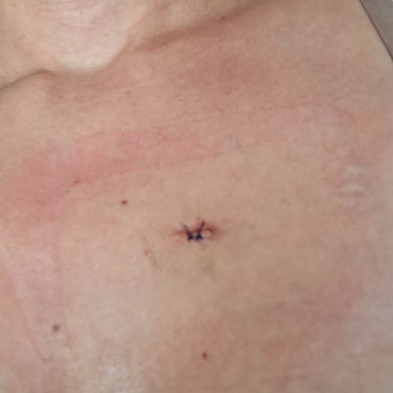 Hipoalerjenik Bantla Alerjik Reaksiyon, Şirketin Altı Aylık Cevapsızlığı