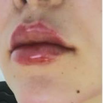 Clinimed Nişantaşı’nda Yetkisiz Estetik Uygulamalar ve Ciddi Fiziksel‑Psikolojik Mağduriyet