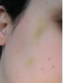 Clinimed Nişantaşı’nda Yetkisiz Estetik Uygulamalar ve Ciddi Fiziksel‑Psikolojik Mağduriyet