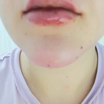 Clinimed Nişantaşı’nda Yetkisiz Estetik Uygulamalar ve Ciddi Fiziksel‑Psikolojik Mağduriyet