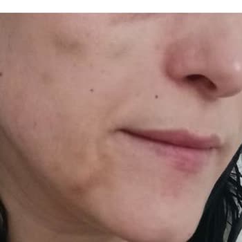 Clinimed Nişantaşı’nda Yetkisiz Estetik Uygulamalar ve Ciddi Fiziksel‑Psikolojik Mağduriyet