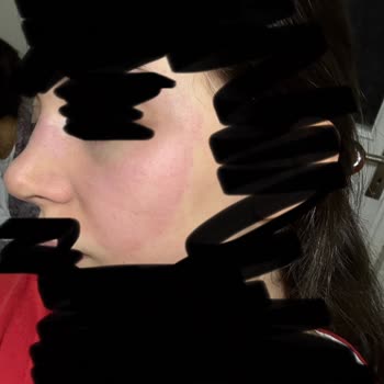 Uni Baby Islak Mendilde Bebek Ve Anne Cildine Yanık Ve Tahriş