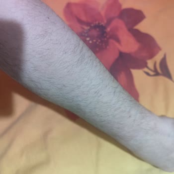 Özlem Kamış Beauty Center Yanıltan Lazer ve Cilt Bakımı Uygulamaları, Cilt Yanığı Ve Sözleşme Dava