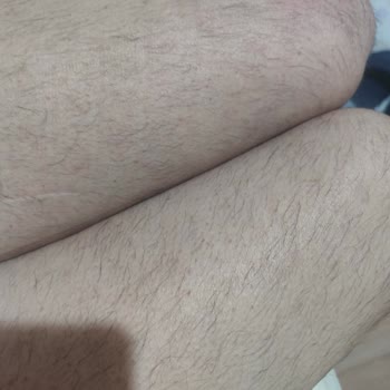 Özlem Kamış Beauty Center Yanıltan Lazer ve Cilt Bakımı Uygulamaları, Cilt Yanığı Ve Sözleşme Dava