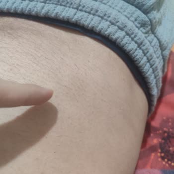 Özlem Kamış Beauty Center Yanıltan Lazer ve Cilt Bakımı Uygulamaları, Cilt Yanığı Ve Sözleşme Dava