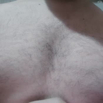 Özlem Kamış Beauty Center Yanıltan Lazer ve Cilt Bakımı Uygulamaları, Cilt Yanığı Ve Sözleşme Dava