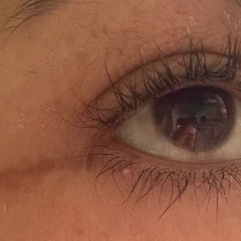 Op. Dr. Yıldız Acar Ebcim Gözaltı Revizyon Ameliyatı Kötüleşti, Ödeme ve Avukat Baskısı