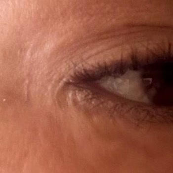 Op. Dr. Yıldız Acar Ebcim Gözaltı Revizyon Ameliyatı Kötüleşti, Ödeme ve Avukat Baskısı