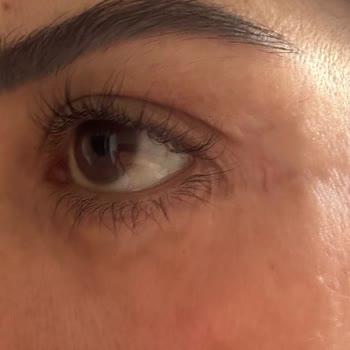 Op. Dr. Yıldız Acar Ebcim Gözaltı Revizyon Ameliyatı Kötüleşti, Ödeme ve Avukat Baskısı