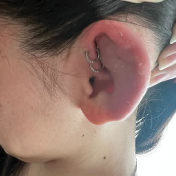 Bellum Tattoo’da Hatalı Piercing Sonrası Şiddetli Enfeksiyon Ve Kulağımda Kayıp Riski