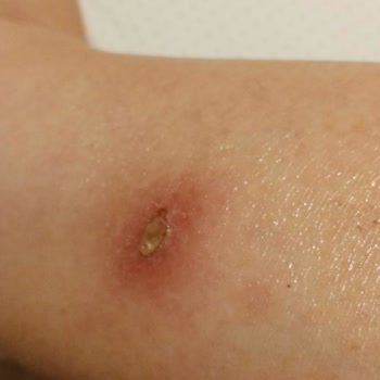 Ayıplı Botta Çıkan Çivi Nedeniyle Yaralanma Ve Bilgilendirme Eksikliği İade Talebi