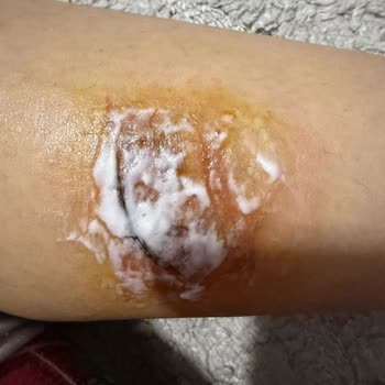 Ankara Ekspresi 4. Vagon Tuvaletinde Bacak Yanığı Güvenlik İhmaline İşaret