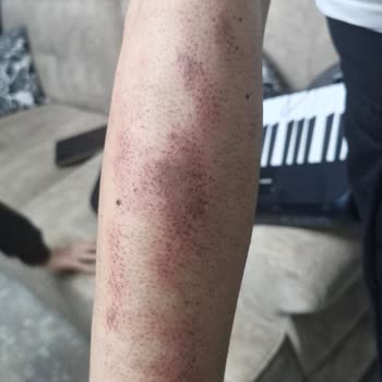 Güzellik Merkezi'nde Epilasyon Sonrası Yanık ve İade Talebi