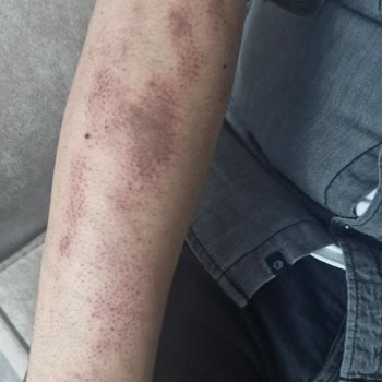 Güzellik Merkezi'nde Epilasyon Sonrası Yanık ve İade Talebi