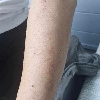 Güzellik Merkezi'nde Epilasyon Sonrası Yanık ve İade Talebi