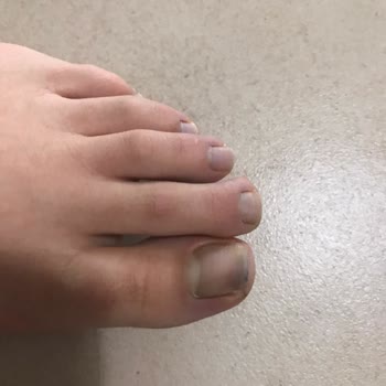 Aldo Botunun Boyası Çorap Ve Tırnaklara Geçti, Kullanılamaz Durumda