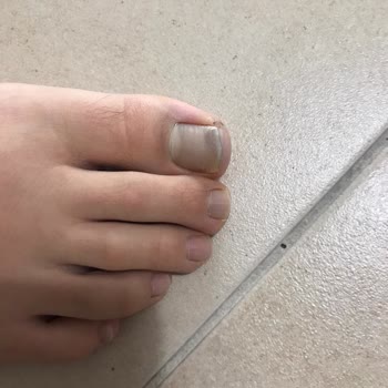 Aldo Botunun Boyası Çorap Ve Tırnaklara Geçti, Kullanılamaz Durumda