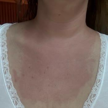 Ciltte Şiddetli Yanma Ve Kırmızılaşma Mağaza Çalışanının Tutumuna Şikayet