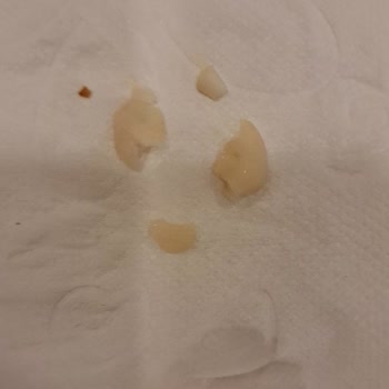 BİM Ürünü İçindeki Sert Mısır Tanesi Nedeniyle Diş Kırılması Ve Şiddetli Ağrı