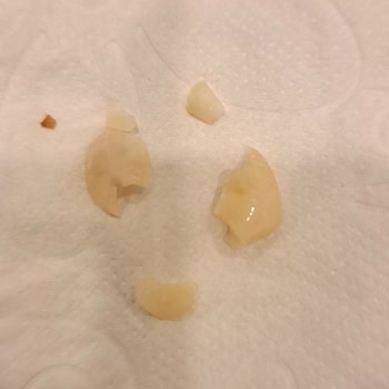 BİM Ürünü İçindeki Sert Mısır Tanesi Nedeniyle Diş Kırılması Ve Şiddetli Ağrı