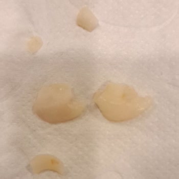 BİM Ürünü İçindeki Sert Mısır Tanesi Nedeniyle Diş Kırılması Ve Şiddetli Ağrı