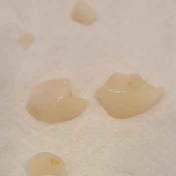 BİM Ürünü İçindeki Sert Mısır Tanesi Nedeniyle Diş Kırılması Ve Şiddetli Ağrı