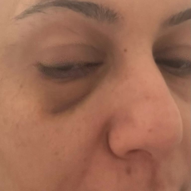 Dermaelite Güzellik Merkezi Yetkisiz 70 Bin Tl Çekimi Sonrası Sağlık Sorunu