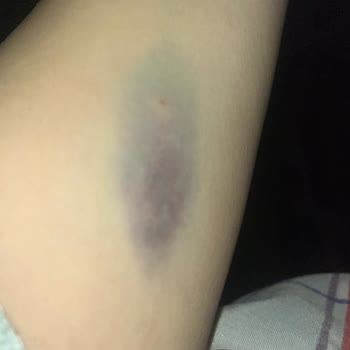 Özel Bilgi Hastanesi (Ankara) Serum Takma Sırasında Hemşirenin Kaba Üslubu