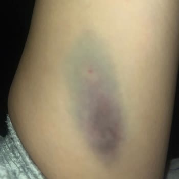 Özel Bilgi Hastanesi (Ankara) Serum Takma Sırasında Hemşirenin Kaba Üslubu