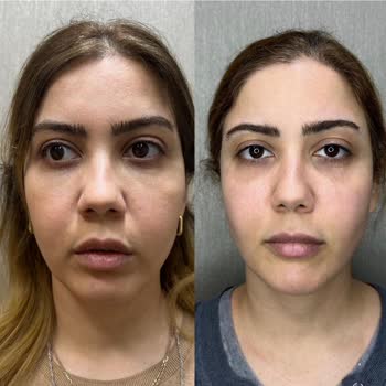 Uyarı Aşırı Yağ Enjeksiyonu Sonrası Yüzde Şiddetli Şişlik Ve Psikolojik Travma