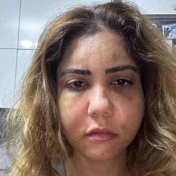 Uyarı Aşırı Yağ Enjeksiyonu Sonrası Yüzde Şiddetli Şişlik Ve Psikolojik Travma