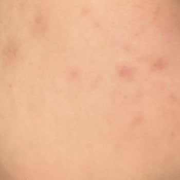 Facelab Cosmetics Cildimde Yanma ve Belirgin Bir Kızarıklık Oluştu