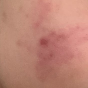 Facelab Cosmetics Cildimde Yanma ve Belirgin Bir Kızarıklık Oluştu