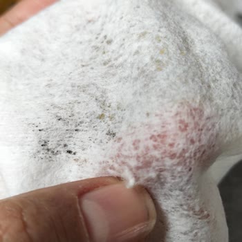 Watsons Dalin Islak Mendilinde Yabancı Madde Nedeniyle Cilt Çizikleri