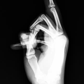 Kepez Devlet Hastanesi’nde Trafik Kazası Sonrası Yanlış Tanı Ve Raporlama İhmali