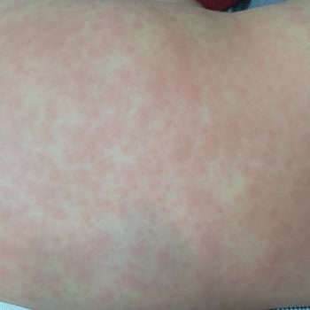 Kızımda Klamoks ES 600 Antibiyotiği Nedeniyle Şiddetli Alerjik Reaksiyon Ve Acil İnceleme Talebi