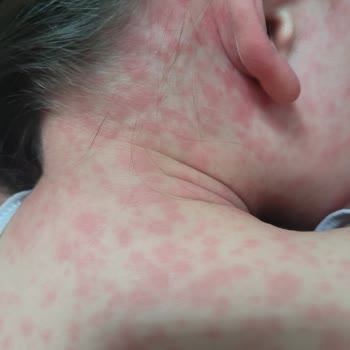 Kızımda Klamoks ES 600 Antibiyotiği Nedeniyle Şiddetli Alerjik Reaksiyon Ve Acil İnceleme Talebi