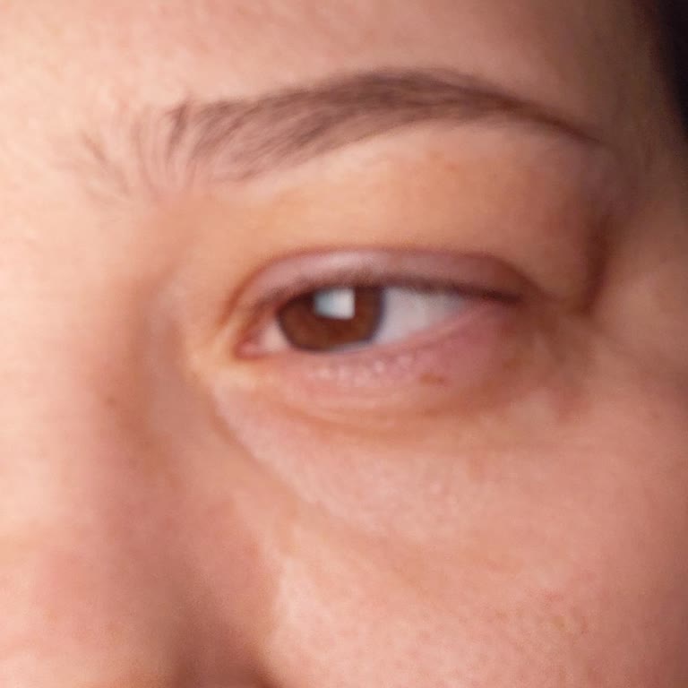 Beaulis Kalem Farı Kullanımından Göz Şişmesi Ve Yaşarma Şikayeti