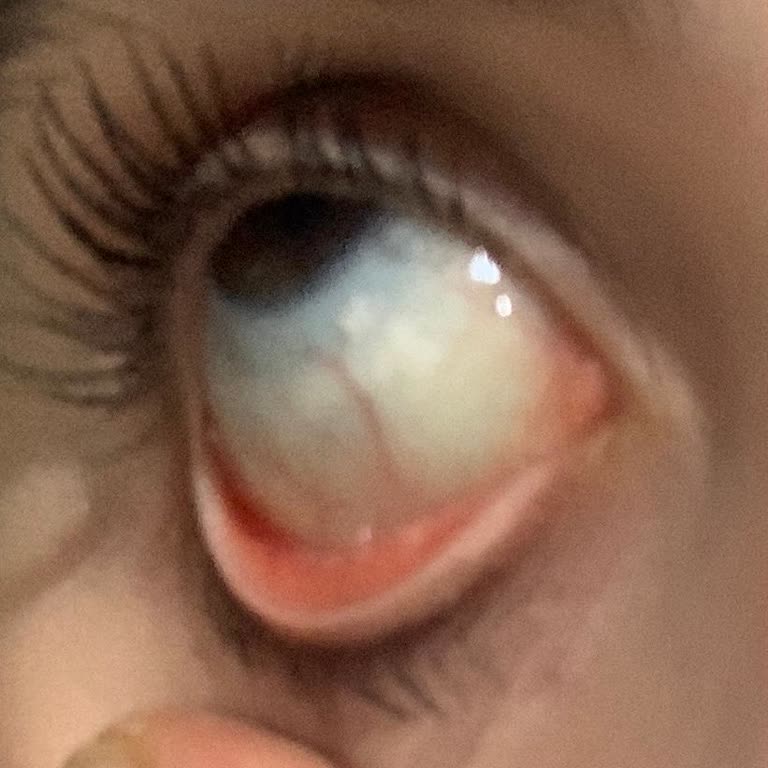 Astigmat Lenste Şiddetli Alerjik Reaksiyon Ve Çelişkili İade Süreci