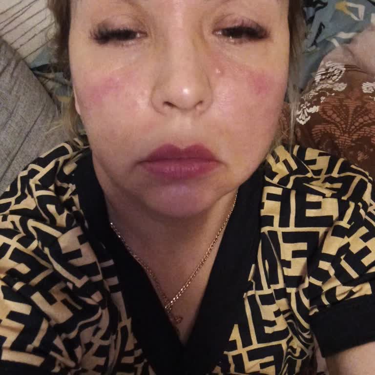 Средство Для Атопического Лица&nbsp;Bioderma&nbsp;Atoderm Intensive сильная аллергическая реакция
