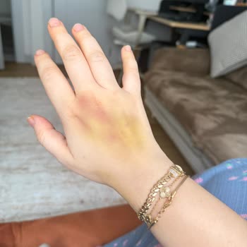 Anestezi Sırasında Damar Yolu Açımında Ağır Acı Ve İhmal