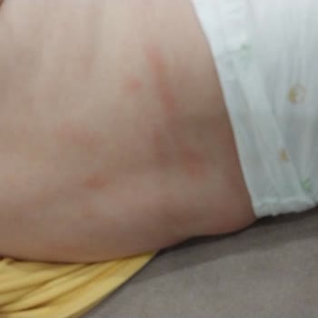 Golden Goat Mama Sonrası Bebekte Şiddetli Döküntü Ve İshal, Cevap Yok