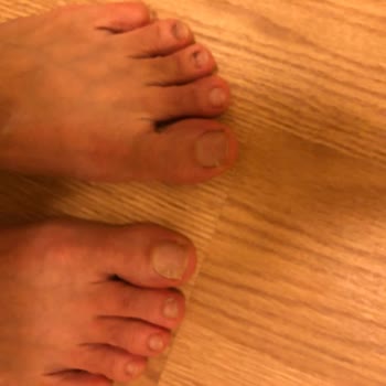 Under Armour Boyner’den Aldığım Ayıplı Ayakkabı Sağlık Sorunları Ve 440 Bin Tl Tedavi Masrafı