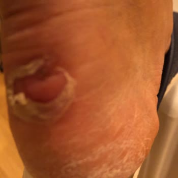 Under Armour Boyner’den Aldığım Ayıplı Ayakkabı Sağlık Sorunları Ve 440 Bin Tl Tedavi Masrafı