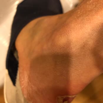 Under Armour Boyner’den Aldığım Ayıplı Ayakkabı Sağlık Sorunları Ve 440 Bin Tl Tedavi Masrafı