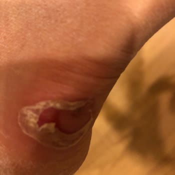 Under Armour Boyner’den Aldığım Ayıplı Ayakkabı Sağlık Sorunları Ve 440 Bin Tl Tedavi Masrafı