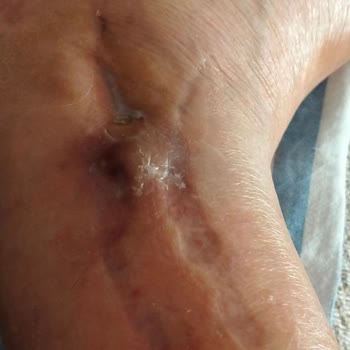 Kapanmamış Dikiş Ve Enfeksiyon Nedeniyle Uzun Süreli Mağduriyet