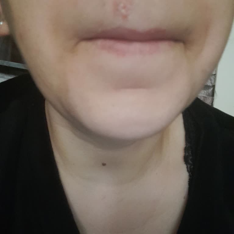 Veet Profesyonel Sir Ağda Bantları Yüzde Şiddetli Cilt Reaksiyonu Ve İade Talebi