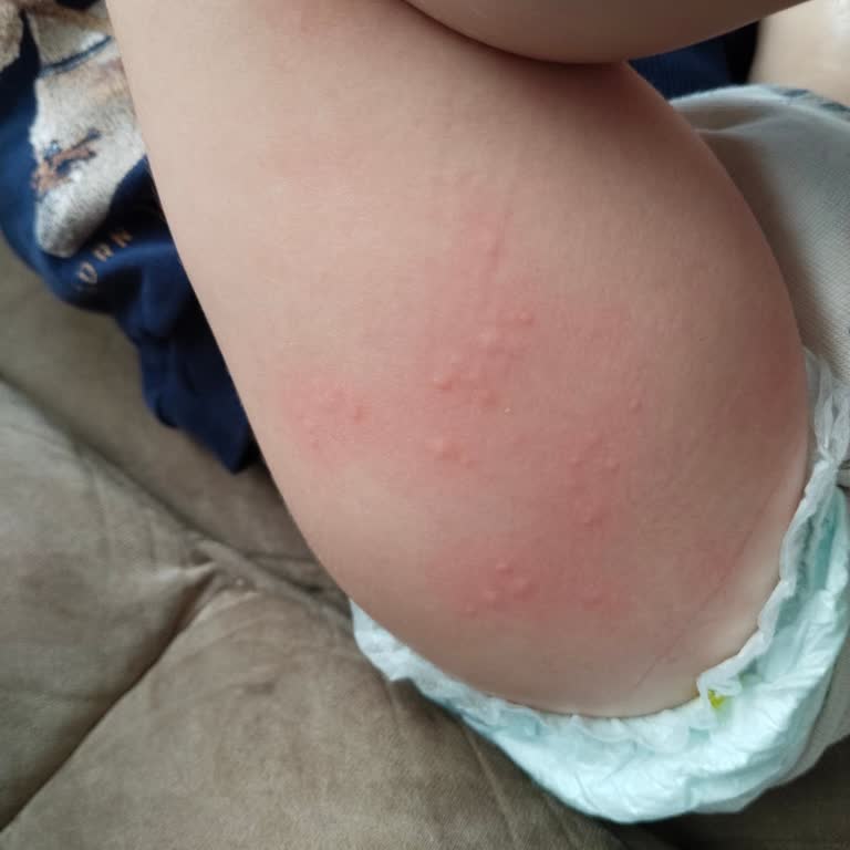 Nutrigen Balık Yağının Çocuğumda Yarattığı Şiddetli Alerjik Reaksiyon